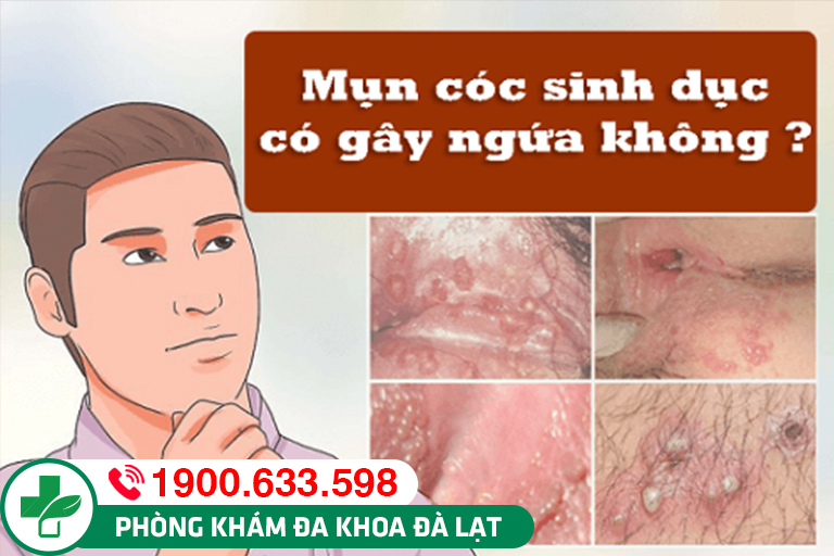 Mụn cóc sinh dục có ngứa không? Có gây đau không?